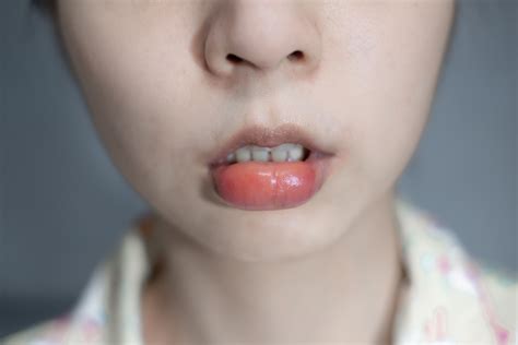 What Helps Swollen Lips After Dental Work Sitelip Org