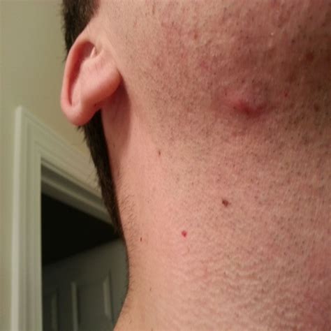 I Have Two Red Bumps On Neck And Jaw