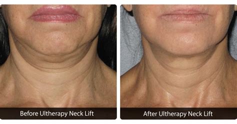 Ultherapy Skin Tightening Before After Photos Northern Virginia Richmond