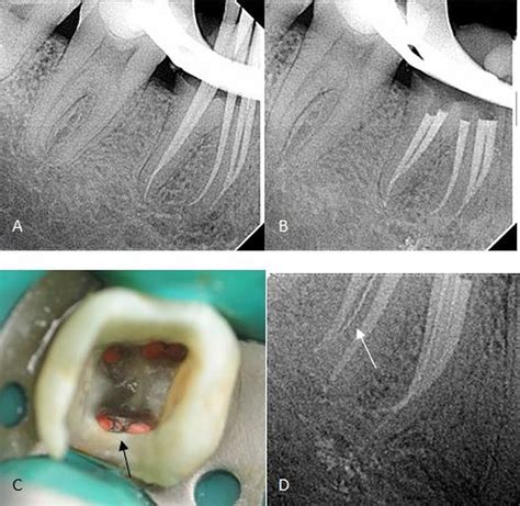 Mandibular First Molar With Six Root Canals A Rare Entity BMJ Case