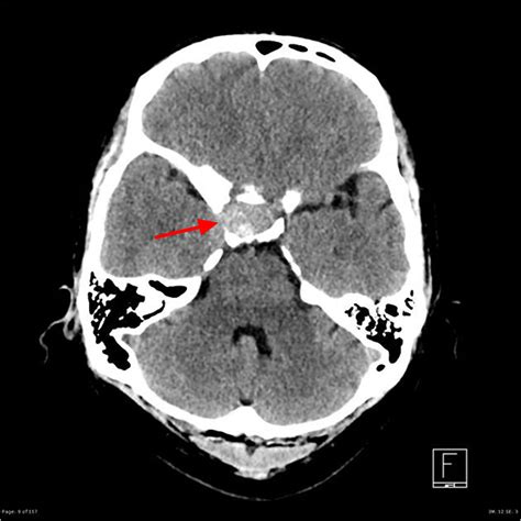 Pituitary Tumor Signs Symptoms Diagnosis Mri Surgery And Treatment
