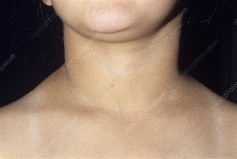 Hypothyroidism Stock Image M1700322 Science Photo Library