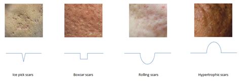Acne Scar Treatment Urepublic Cosmetic Dermatology And Veins