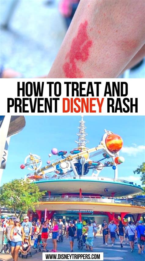 How To Treat And Prevent Disney Rash Disney Rash Disney Vacation