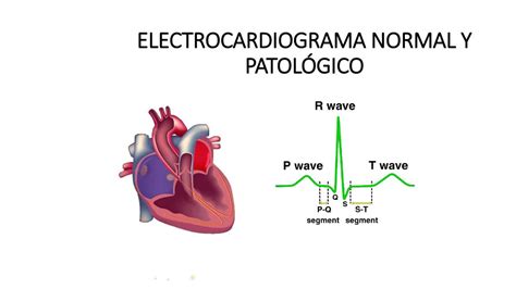 ELECTROCARDIOGRAMA NORMAL Y PATOLÓGICO uDocz