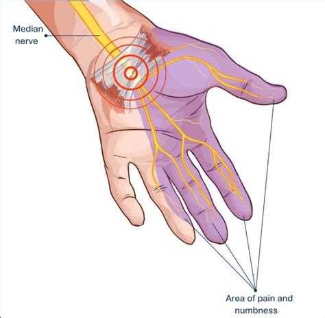 Hand Pain And Carpal Tunnel Syndrome Cts