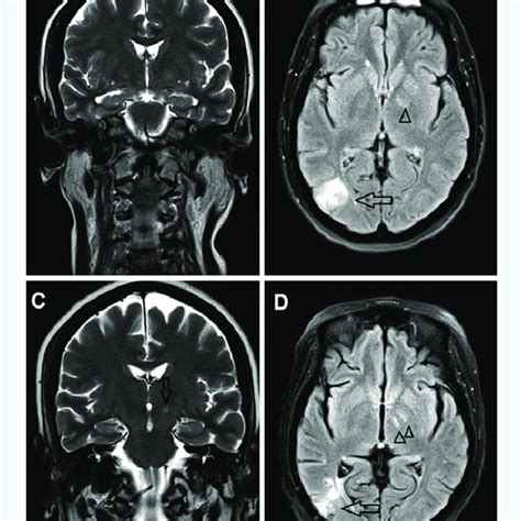 Brain Mris A An Initial Brain Mri In A Coronal T2 Weighted Sequence