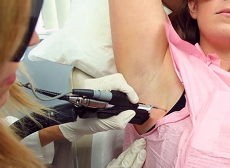 Laser hair removal is typically a very tolerable procedure. Laser Hair Removal San Diego, CA | Cosmetic Laser Dermatology
