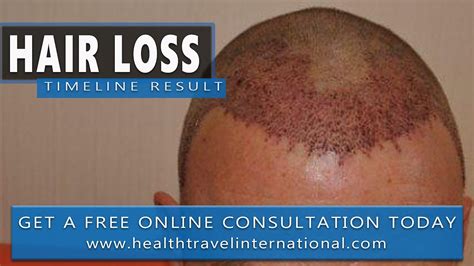 Fue hair transplant how fue works in fue hair transplants, there is minimal bleeding, and recovery is usually complete within seven it can be hard to know if fue is right for you, or even if you are a good candidate for fue hair transplantation. FUE Hair Transplant - 12 Month Result - Hair loss ...
