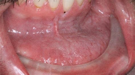 Breakthrough Clinical Oral Pathology Case No 22 Dentistry Iq