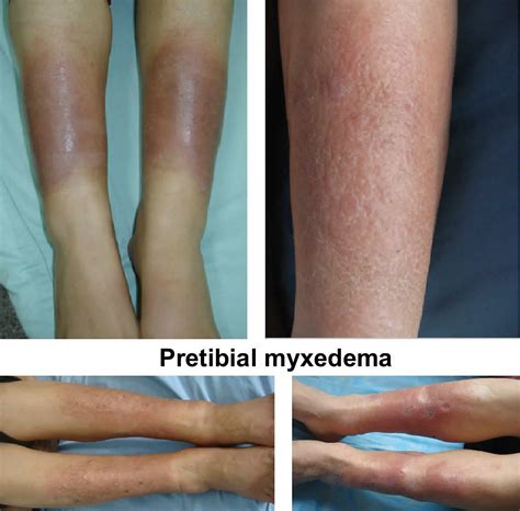 Pretibial Myxedema Causes Symptoms Diagnosis Treatment And Prognosis