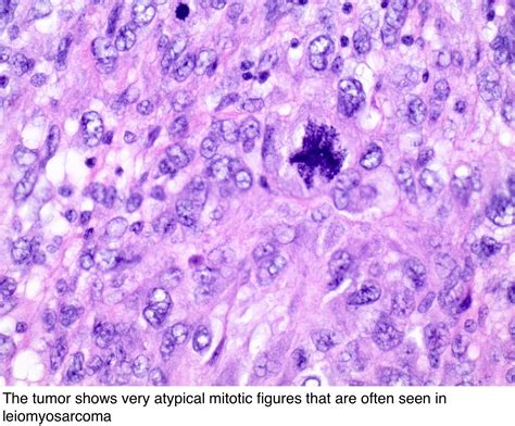 Pathology Outlines Leiomyosarcoma