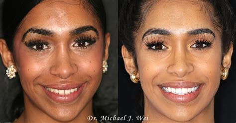 Manhattan Porcelain Veneers Makeover Smiles In Nyc By New York City