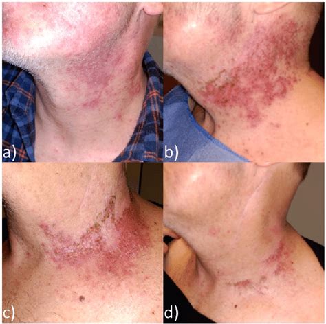 Radiation Dermatitis Evolution 7 Days After Wound Dressing Application