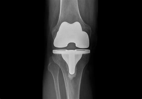 Customized Implants For Knee Replacements Mayo Clinic