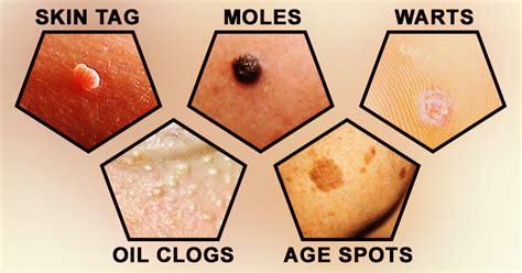 How To Remove Moles Skin Tags Warts Spots And Blackheads Easily And