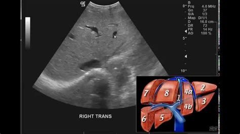 Introduction To The Interpretation Of Abdominal Ultrasound Youtube