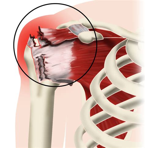Shoulder Rotator Cuff Repair Archives Orthopaedic And Spine Center My
