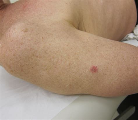When Is Laser Treatment The Best Option For Skin Cancer Womens