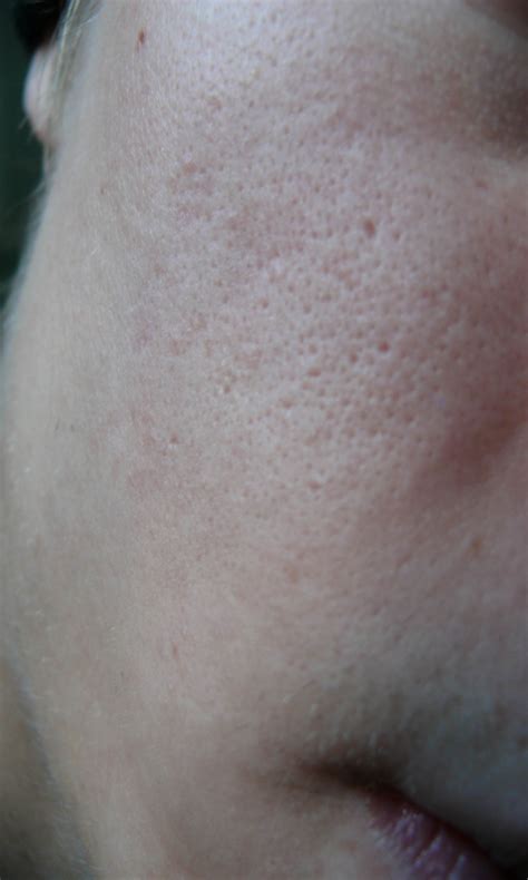 Scarred Pores Pic Help Scar Treatments