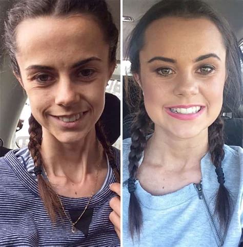 45 Before After Photos Of People Who Beat Anorexia True Activist