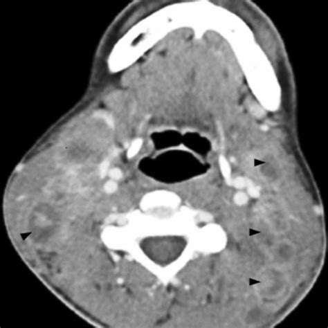 Contrast Enhanced Computed Tomography Of The Neck On First Admission