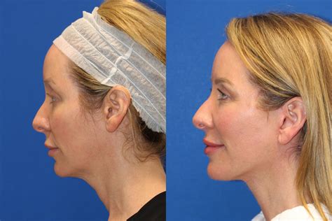 Patient 76129747 Vertical Restore® Facial Rejuvenation Before And After Photos Carmel Valley