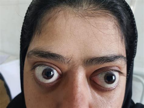A Young Female Patient With Bulging Eyes Feverpk