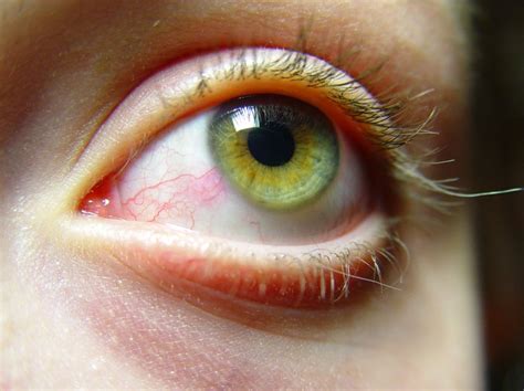 How To Get Rid Of Red Puffy Eyes Livestrongcom