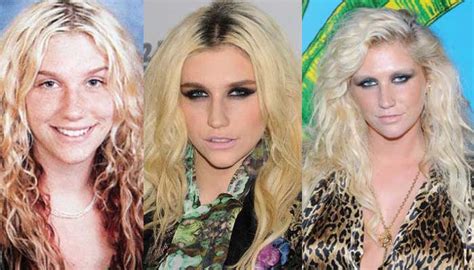 Kesha Plastic Surgery Before and After Pictures 2018