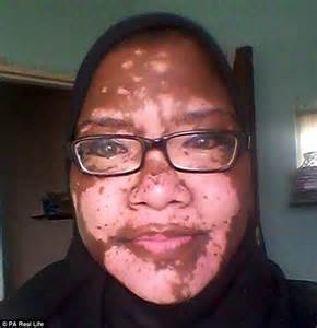 South African Woman With Severe Vitiligo Posts Her First Ever Selfie