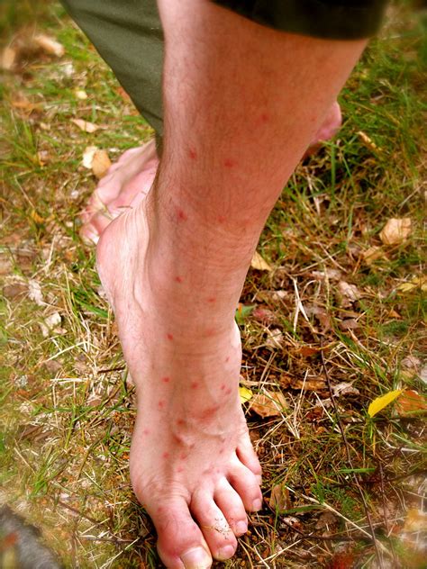 Mosquito Bitten Feet Jannes Foot After Getting An Unhealt Flickr