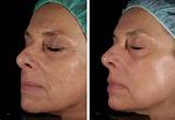 Recovery Time Co2 Laser Skin Resurfacing Images