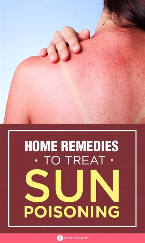 10 Natural Remedies To Treat Sun Poisoning At Home Sunburn Treatment Sunburn Remedies Home