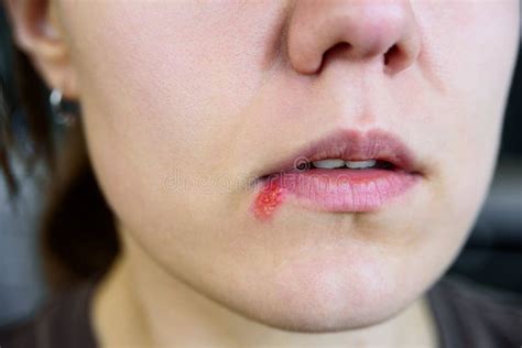 Herpes On Young Woman Lips Stock Image Image Of Illness 130073679