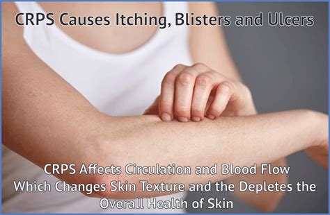 Crps And Itchy Blistering Skin Complextruths