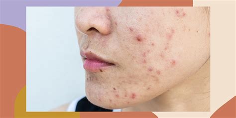 How To Treat Cystic Acne According To Dermatologists Hellogiggles