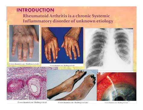 Clinical Presentation On Rheumatoid Arthritis Amavata