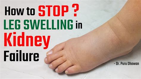 How To Stop Leg Swelling In Kidney Failure Youtube