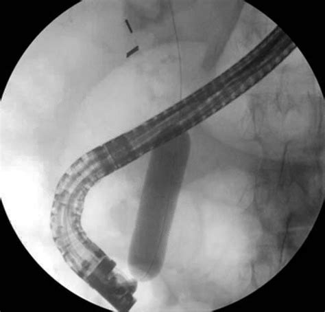 Endoscopic Papillary Large Balloon Dilation For Large Common Bile Duct