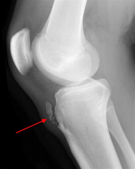 Osgood Schlatter Disease Causes Symptoms Prognosis And Treatment