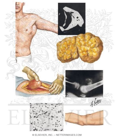 Lipoma Neurofibroma Myositis Ossificans