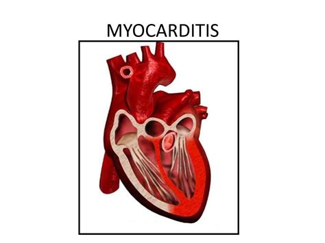 The duration of problems can vary from hours to months. Myocarditis