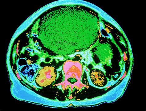 Coloured Ct Scan Of Ovarian Cancer Photograph By Gjlpscience Photo Library