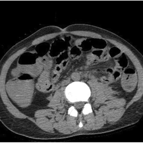 Ct Of The Abdomen A The Ct Scan Shows Multiple Air Fluid Levels In