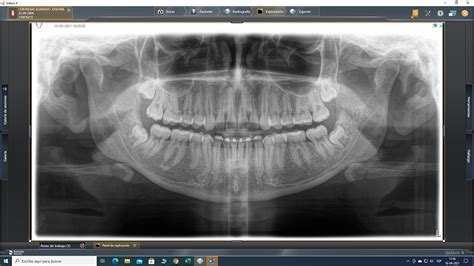 Panorámica Ortopantomografía Odonto Imax