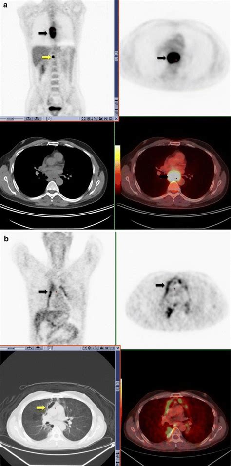 0 18f18 Fdg Pet Ct Performed In A 52 Year Old Male With Newly Diagnosed