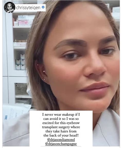 Chrissy Teigen Got An Eyebrow Transplant Here S What To Know About The Cosmetic Procedure