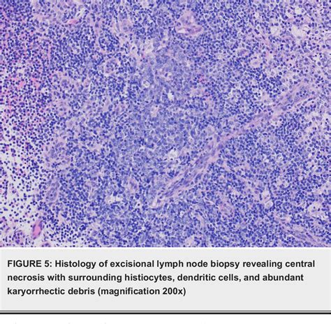 Figure 5 From Kikuchi Fujimoto Disease With Systemic Lupus