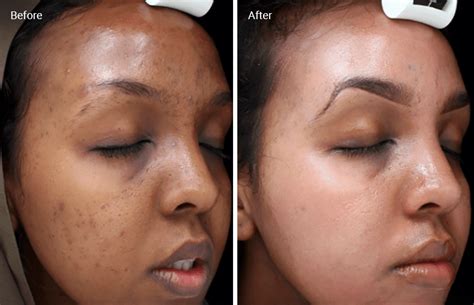 Chemical Peels For Acne Scars Efficacy Before And Afters At Home Uses